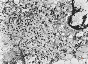 M, 63y. | suprarenal neuroblastoma